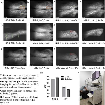 Case Report: The application of novel imaging technologies in lower extremity peripheral artery disease: NIR-II imaging, OCTA, and LSFG